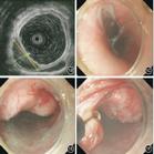 经黏膜下隧道内镜肿瘤切除术治疗上消化道多发黏膜下肿瘤的临床应用