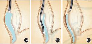 改良经口内镜下肌切开术治疗贲门失弛缓症