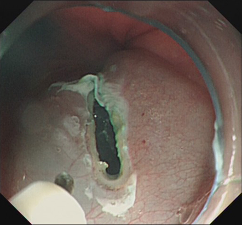 经口内镜下肌切开术治疗贲门失弛缓症操作要点及其现状