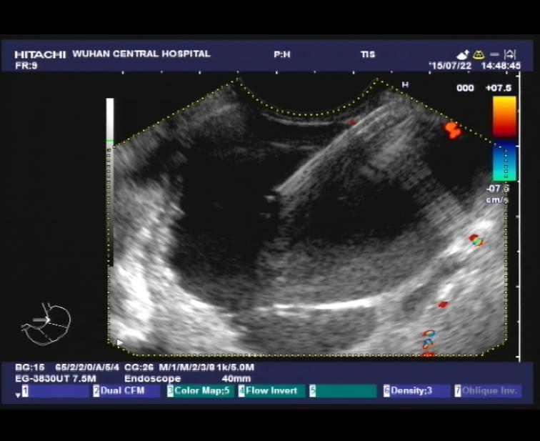 【2016年第6期】内镜超声引导下细针抽吸术治疗肝左叶囊肿的初步应用