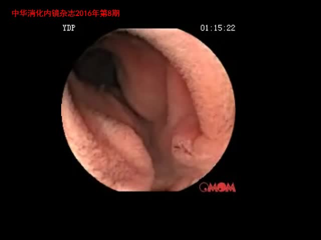 潜水胶囊内镜在小肠疾病诊断中的应用