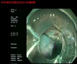 多环黏膜套扎切除术在难治结肠侧向发育型肿瘤治疗中的应用