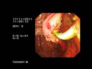 内镜切除术治疗十二指肠乳头部肿瘤