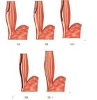 改良经口内镜下肌切开术(Liu-POEM)在治疗贲门失弛缓症中的临床应用