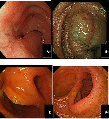 单气囊小肠镜诊治不同类型小肠疾病的价值分析