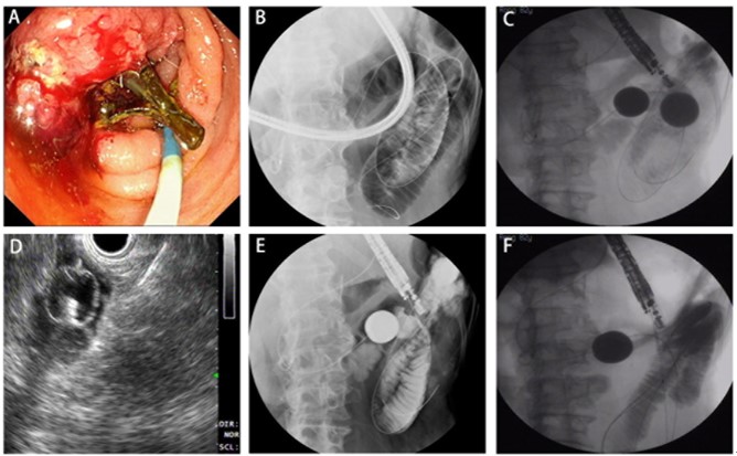 超声内镜引导球囊辅助的胃肠吻合术在治疗恶性胃流出道梗阻中的初步应用