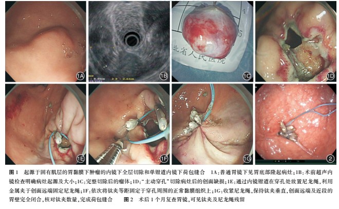 单钳道内镜下荷包缝合法封闭贲门及胃底黏膜下肿瘤术后创面缺损的临床应用评价