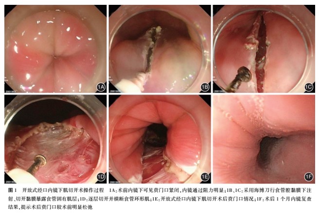 开放式经口内镜下食管肌切开术治疗贲门失弛缓症