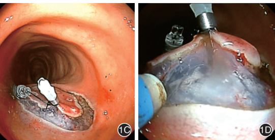 新型磁力锚导引系统在内镜黏膜下剥离术中的应用